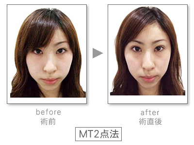MT�@Before&After