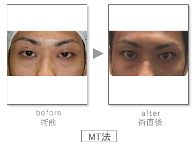 MT�@Before&After