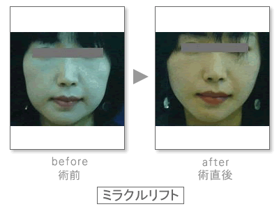 �~���N�����t�g�@Before&After