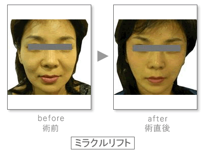 �~���N�����t�g�@Before&After