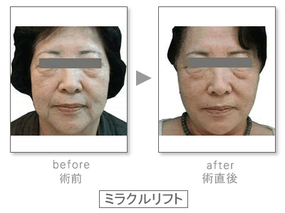 �~���N�����t�g�@Before&After