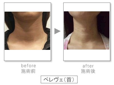 �y�����F�@Before&After