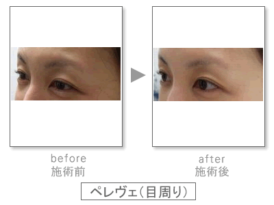 �y�����F�@Before&After