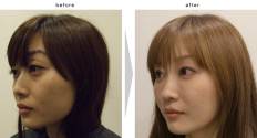 Non-Incisional Blephoroplasty