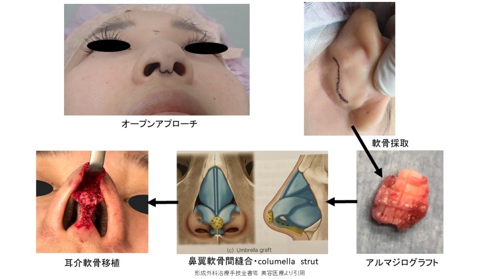団子鼻、鼻尖形成、鼻尖縮小、耳介軟骨移植、アルマジログラフト、鼻プロテーゼ