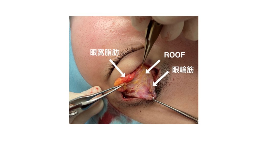 眼窩脂肪除去、ROOF除去、タルミ取り、腫れぼったさ改善