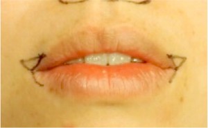 口角が下がっているのが気になる方に