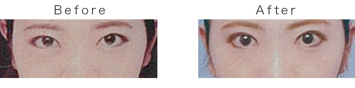 黒目整形（二重まぶた＋眼瞼下垂（切開なし））