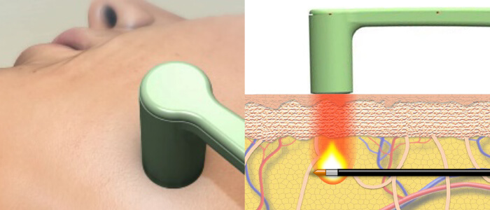 専用のハンドピースで直接皮膚に熱を加えます