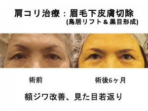 肩コリ治療：眉毛下皮膚切除