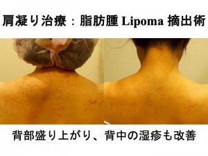 肩凝り外来 (筋膜リリース注射、肩コリボトックス、眉毛下皮膚切除)