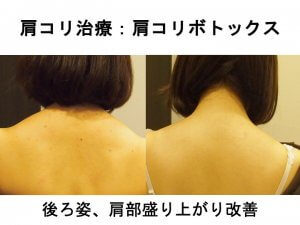 肩コリ治療：肩コリボトックス