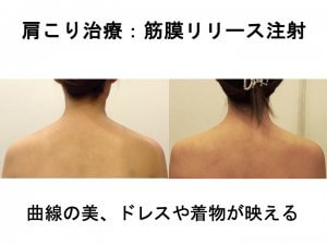 肩こり治療：筋膜リリース注射