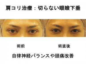 肩コリ治療：切らない眼瞼下垂