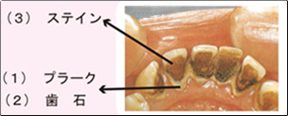 デンタルクリーニング