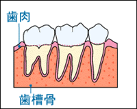 歯周病について