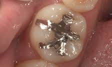銀歯を白に変える方法 ダイレクトボンディング