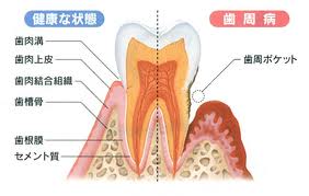 本当は恐〜い歯周病菌！