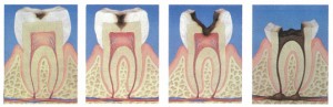 抜歯の判断基準について