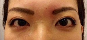 涙袋形成 hyaluronic acid injection for lower eyelid