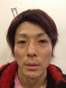 切らない眼瞼下垂手術　Double Eyelid Surgery + Blepharoplasty (no incision)