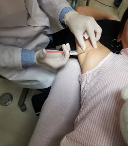 ワキボトックス Botox injection for armpit