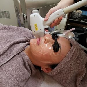 顔の脱毛　laser hair removal for face