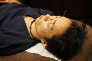 眼精疲労の美容鍼治療　Cosmetic Acupuncture