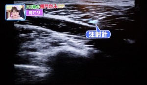 １分で肩こりが消える_筋膜（きんまく）注射_肩こり改善_16